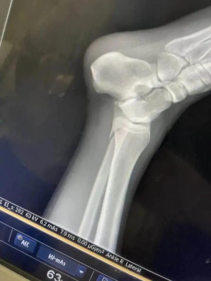 知名综艺录制现场突发意外,多人摔骨折!节目组不赔钱?回应来了