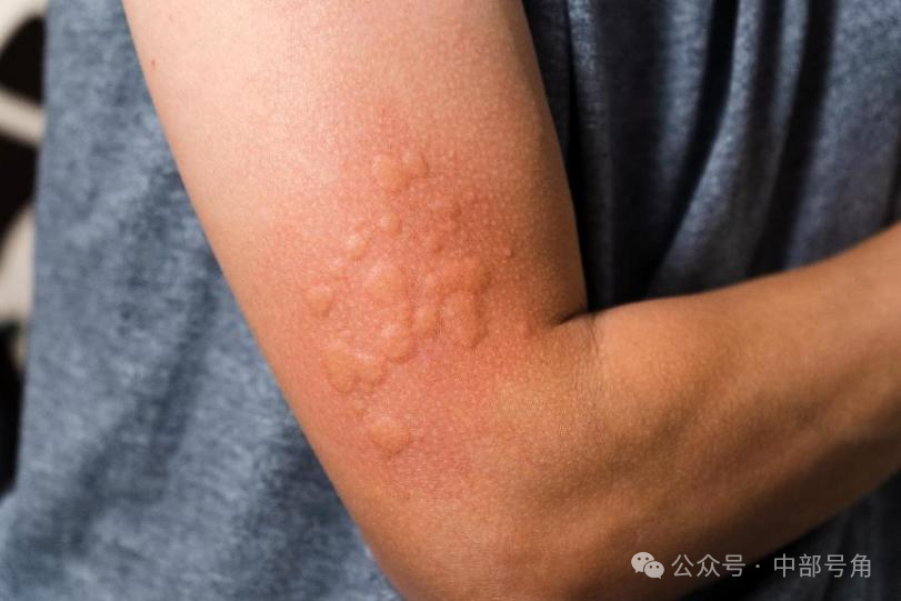 中部云健康 | 荨麻疹,一个让人提心吊胆的"过敏大魔王