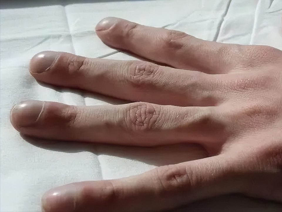 早期发现手指异常,有助于及早发现潜在的肺部健康问题,从而采取有效的