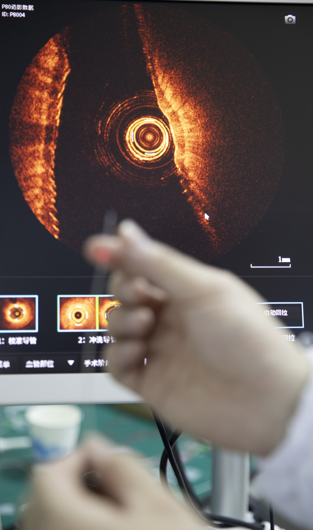 科创故事汇|朱锐:点亮oct技术服务临床的"微光"_腾讯新闻