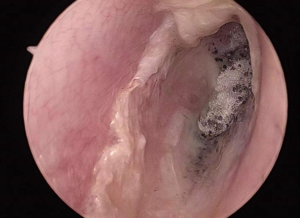 专家表示:酒精无法彻底杀灭真菌