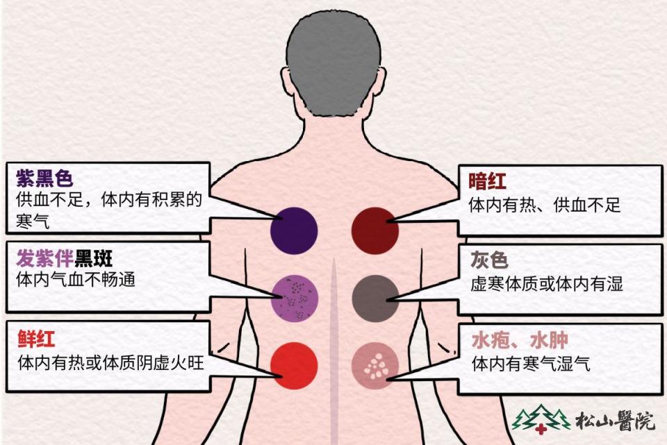 拔罐颜色越深毒越多?