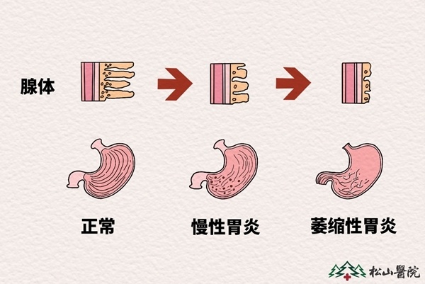 萎缩性胃炎卡通图片