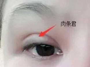这次真急了!我的"肉条感"双眼皮,还有救吗?