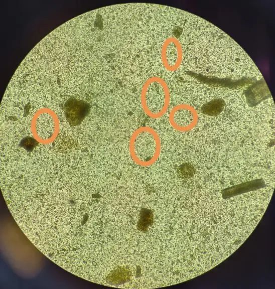 人芽囊原虫感染,你知多少?