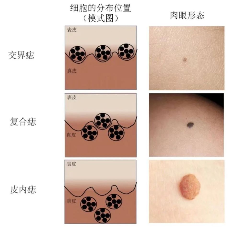 身上的黑痣,什么情况需要治疗?