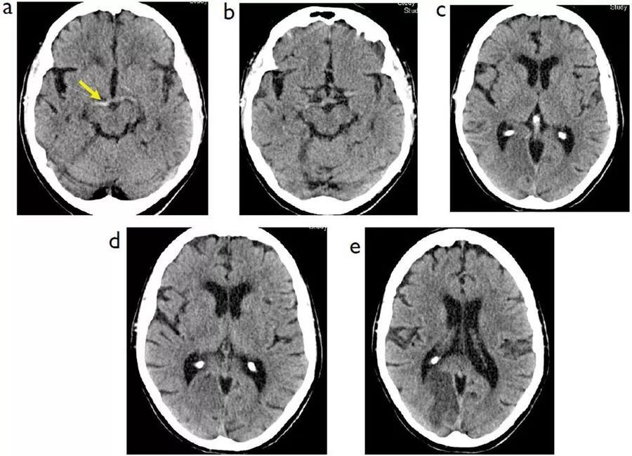 脑干梗死ct图片图片