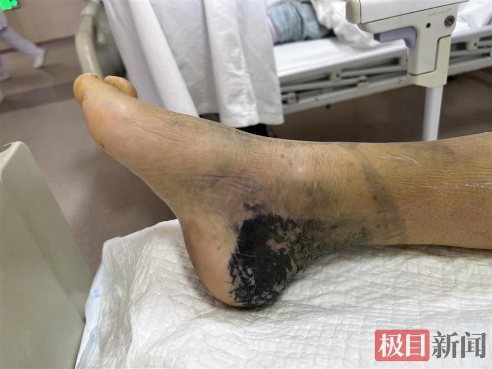 扭伤脚踝听信偏方自行外敷三天，竟致右脚踝韧带断裂？