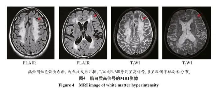 wmh定义为脑白质内形状不一,大小不等的异常信号区域.
