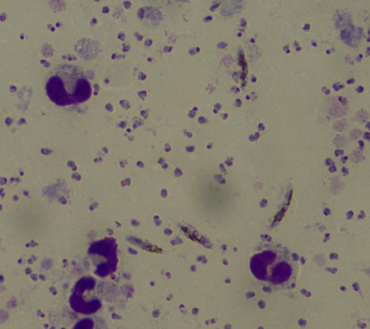 感染间日疟原虫的患者外周血可见各发育阶段的形态分享