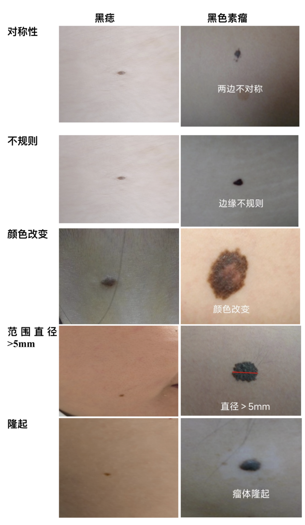 "痣"之不理,还是专心"治痣"