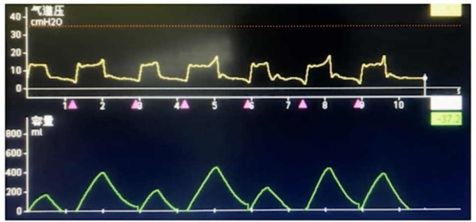无创呼吸机怎么调参数无创呼吸机 4 大模式与参数调节，看完你就全明白了！_https://www.jmylbn.com_新闻资讯_第3张