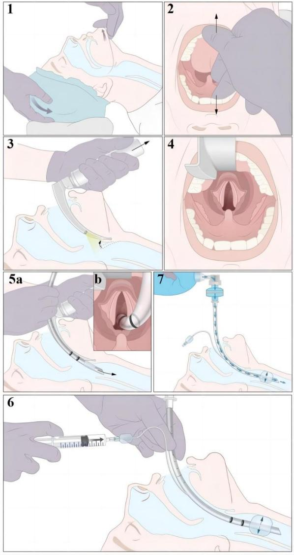 气管插管牙垫怎么放气管插管详细步骤（附多图）_https://www.jmylbn.com_新闻资讯_第7张