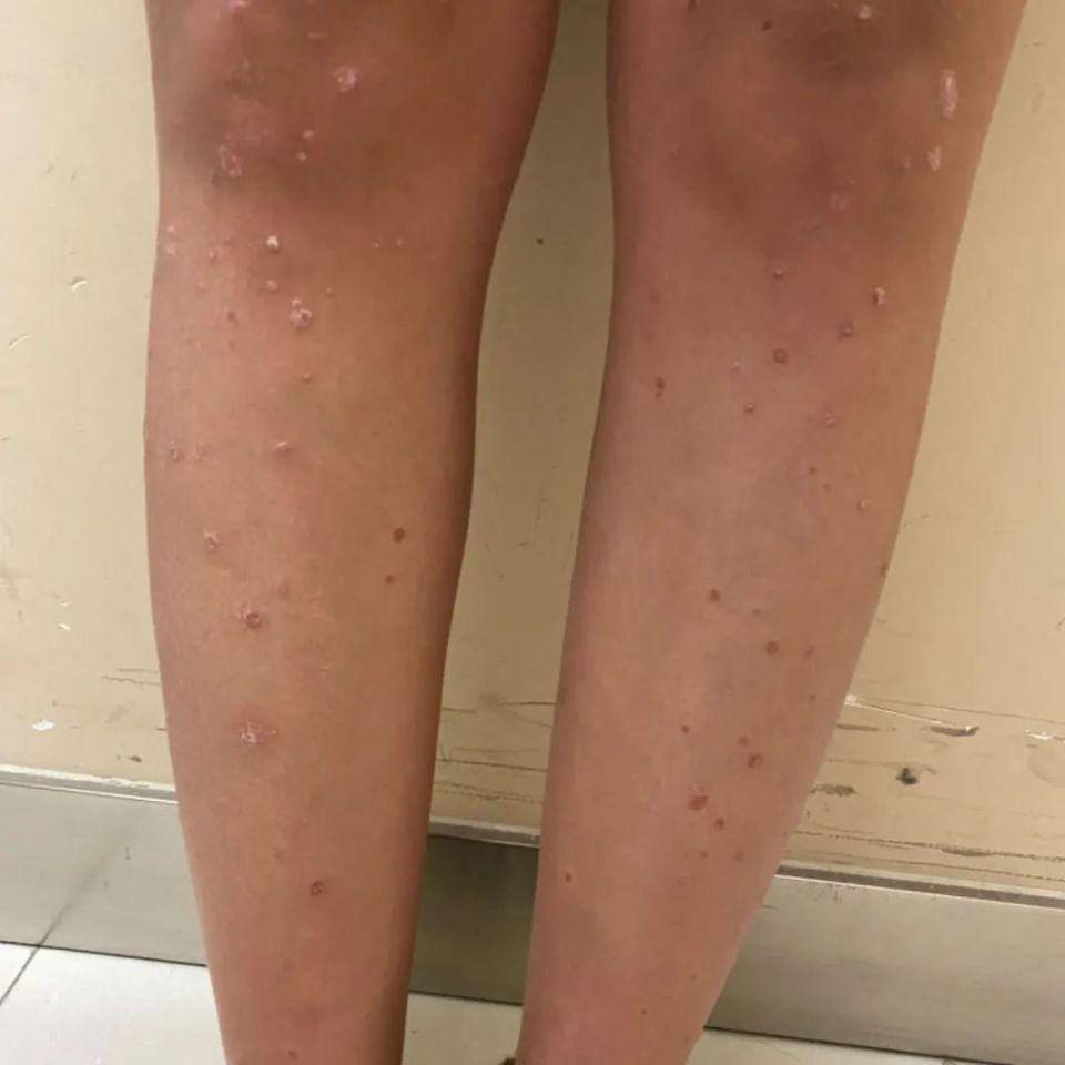 【岐黄科普】皮肤"顽症"并不可怕,皮肤科专家带您正确认识银屑病