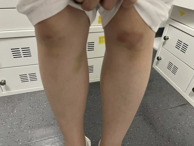 她的膝盖跪紫了网友希望她万紫千红