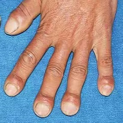 浙江一23岁小伙手指末端肿大就像"青蛙趾",病源竟然在妈妈身上?