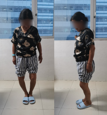 老人重度膝盖内翻走路困难 千里赴莞手术后行走自如