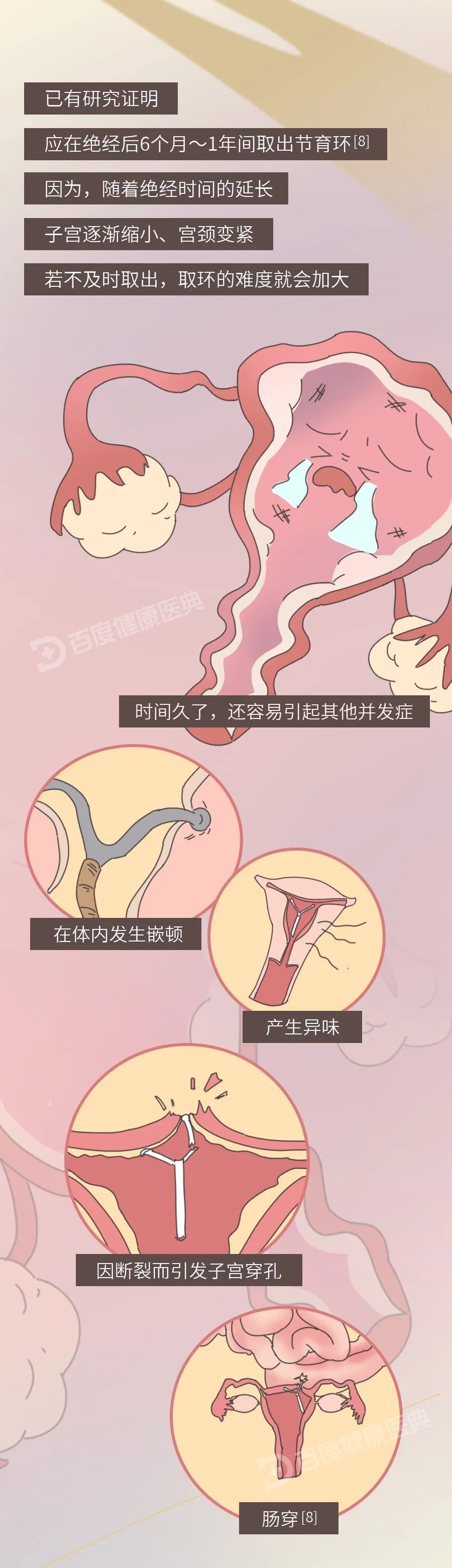 女人上节育环价格表图片