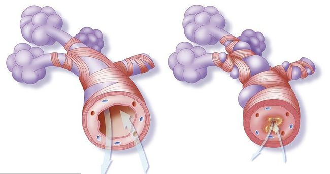 当患者严重缺氧无法通气,你考虑喉痉挛 or 支气管痉挛?