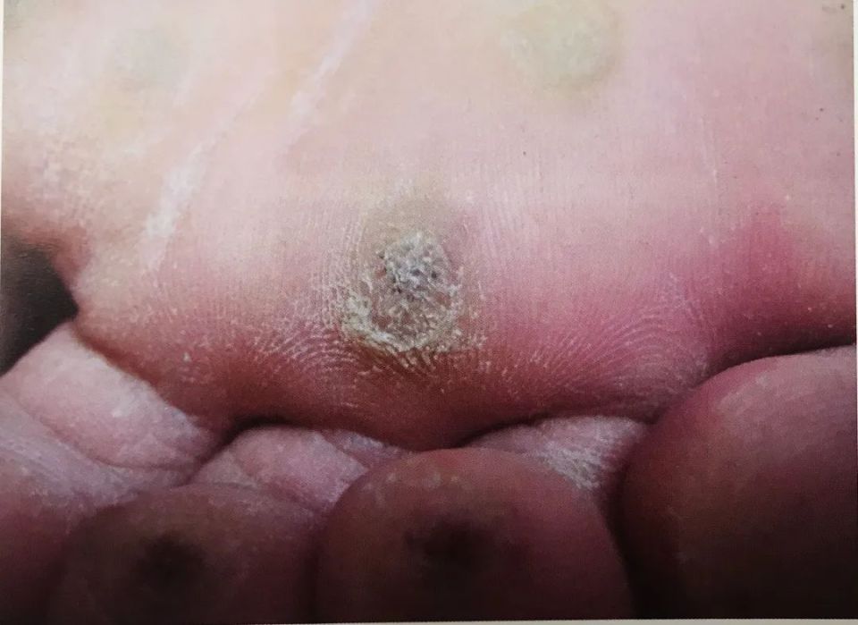 跖疣是发生在足底的寻常疣,多由 hpv 病毒感