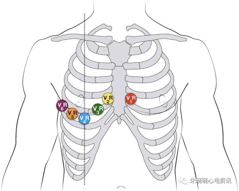 胸前导联位置图片图片