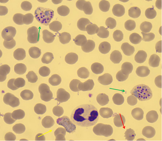 患者外周血可见各发育阶段的间日疟原虫的形态 (分享常见的疟原虫形态