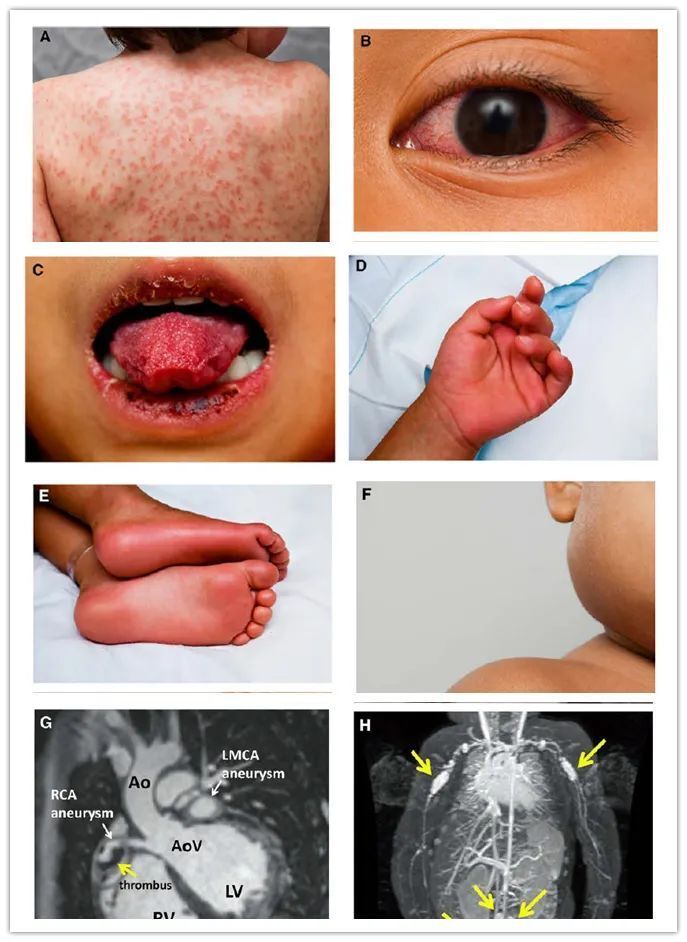儿童川崎病症状图片