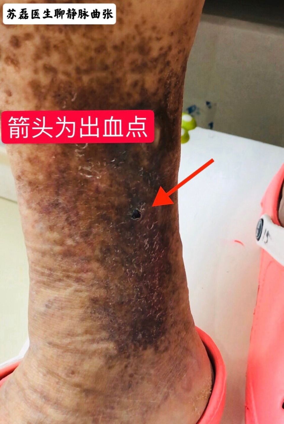 苏磊医生:静脉曲张导致出血,如何防范风险?