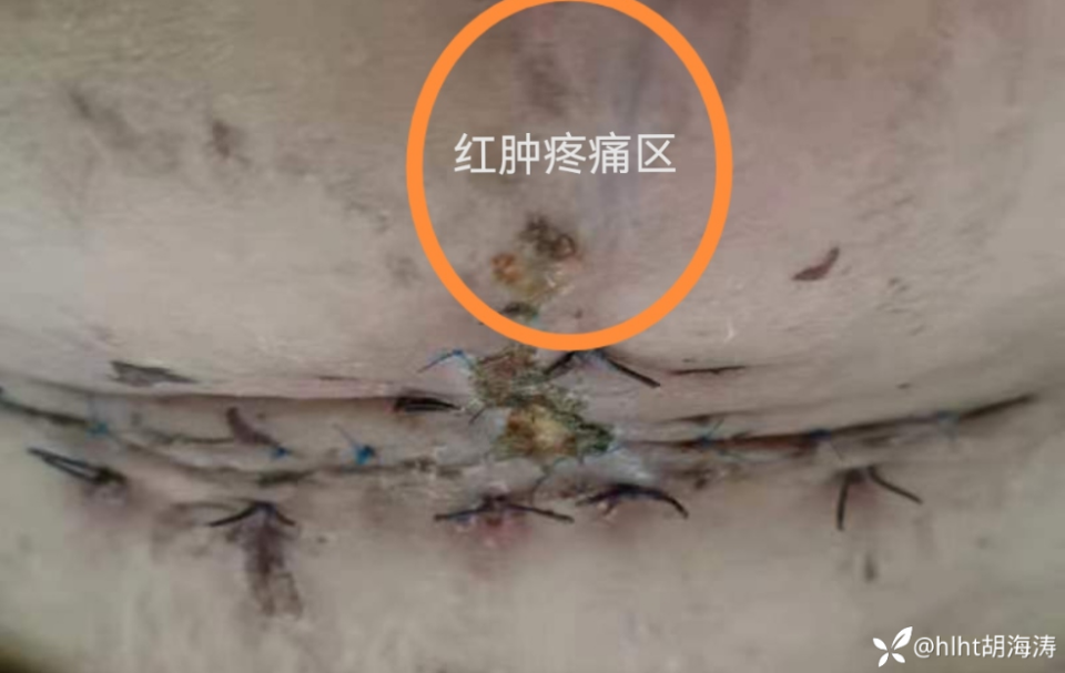 患者因伤口已经治疗快 7 周,如何才能彻底解决问题?