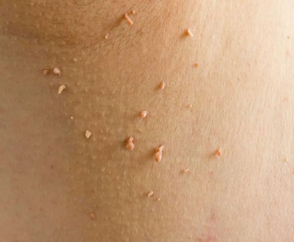 脖子上长这种小肉粒,不是普通皮肤病,可能感染了hpv!