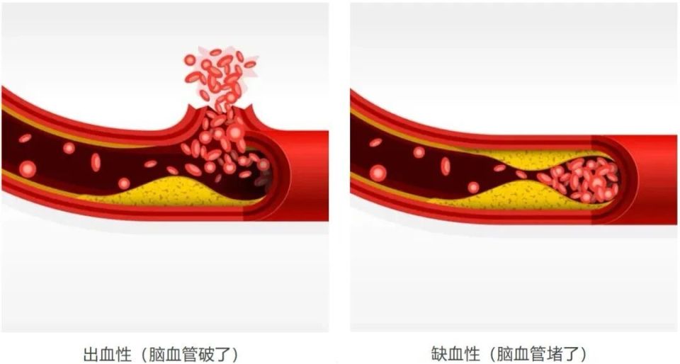 3个看似无关的表现，其实是“中风前兆”_腾讯新闻