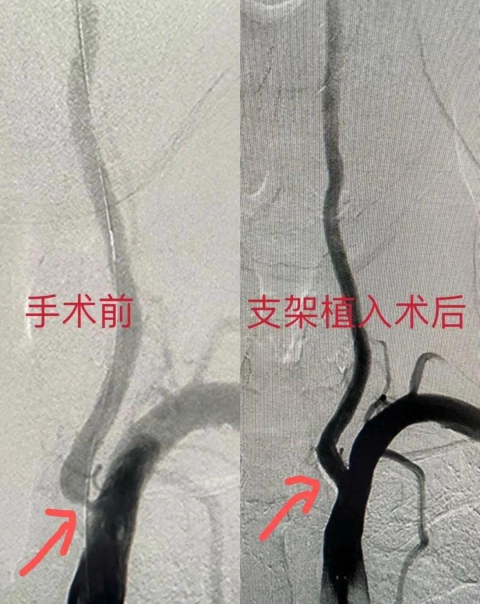 由于罗爷爷动脉狭窄极其严重,脑梗死再发风险极高,一旦再次出现血管