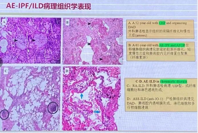 曹孟淑教授：AE-IPF/ILD 诊断和治疗进展_腾讯新闻