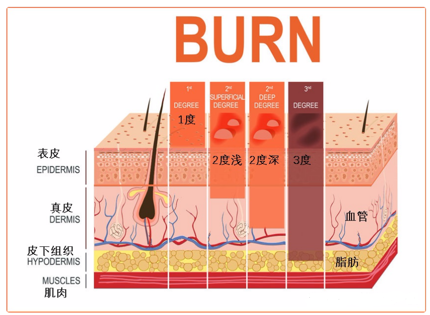 創面該如何分類?重組Ⅲ型人源化膠原蛋白可促進創面癒合!_騰訊新聞