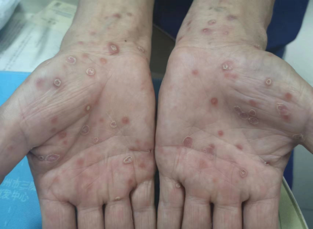 "久治不愈的玫瑰疹"——梅毒非特异性抗体快速血浆反应素试验(rpr)假