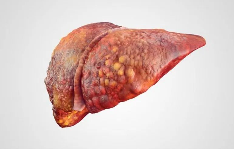 肝硬化的4个时期,看看你是哪个时期?