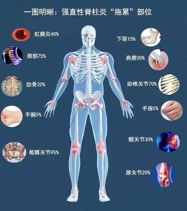不死的癌症-强直性脊柱炎的自白书-腾讯新闻