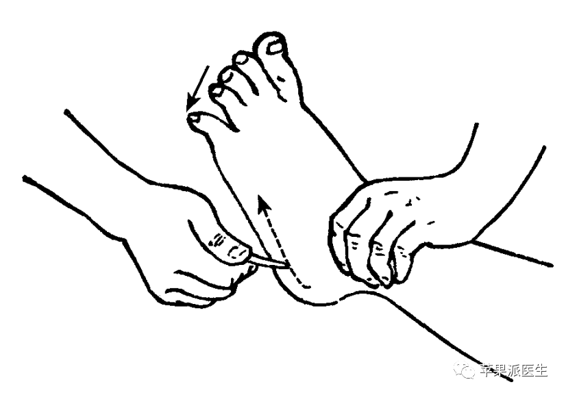 理解babinski征,划对babinski征