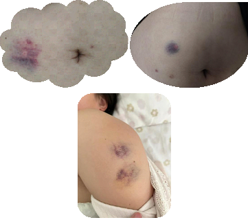 打肝素怎么拔针低分子肝素应该怎样注射？一文详细总结！_https://www.jmylbn.com_新闻资讯_第1张