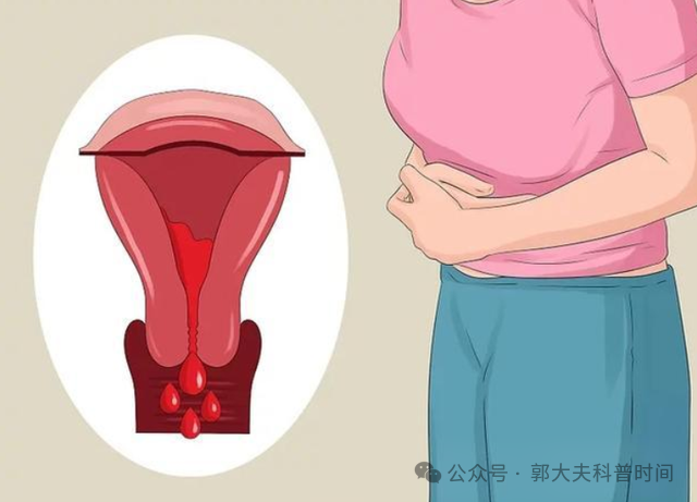 子宫内膜癌的早期症状图片