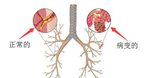 沈阳燕都医院怎么样,慢性支气管炎引发肺气肿怎么办?