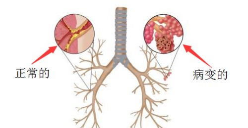 支气管炎的位置图片图片