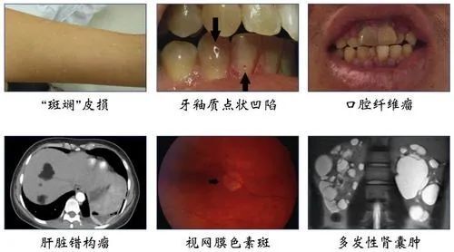 結節性硬化症關愛日|本以為抖動是缺鈣,白斑是胎記,差點被耽誤的罕見