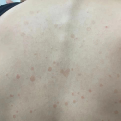 花斑癣的临床表现马拉色菌的免疫荧光镜检和koh直接镜检花斑癣顾名思