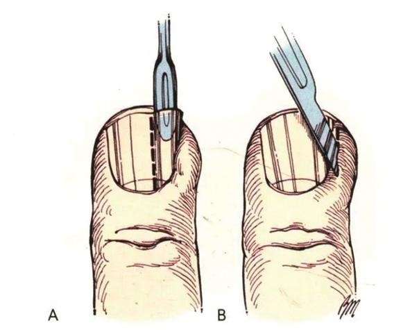 指甲剪太短小心甲沟炎
