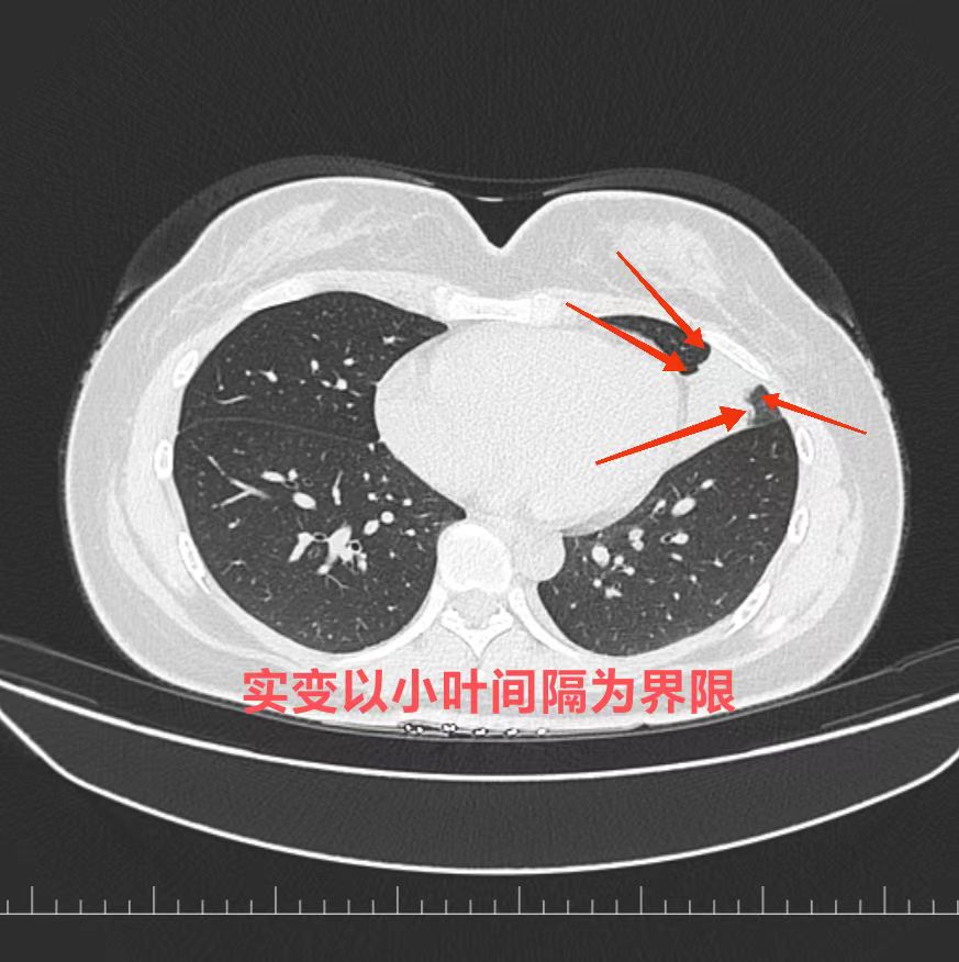 如何在肺 ct 上一眼识别致病菌? | 读片挑战第 14 弹