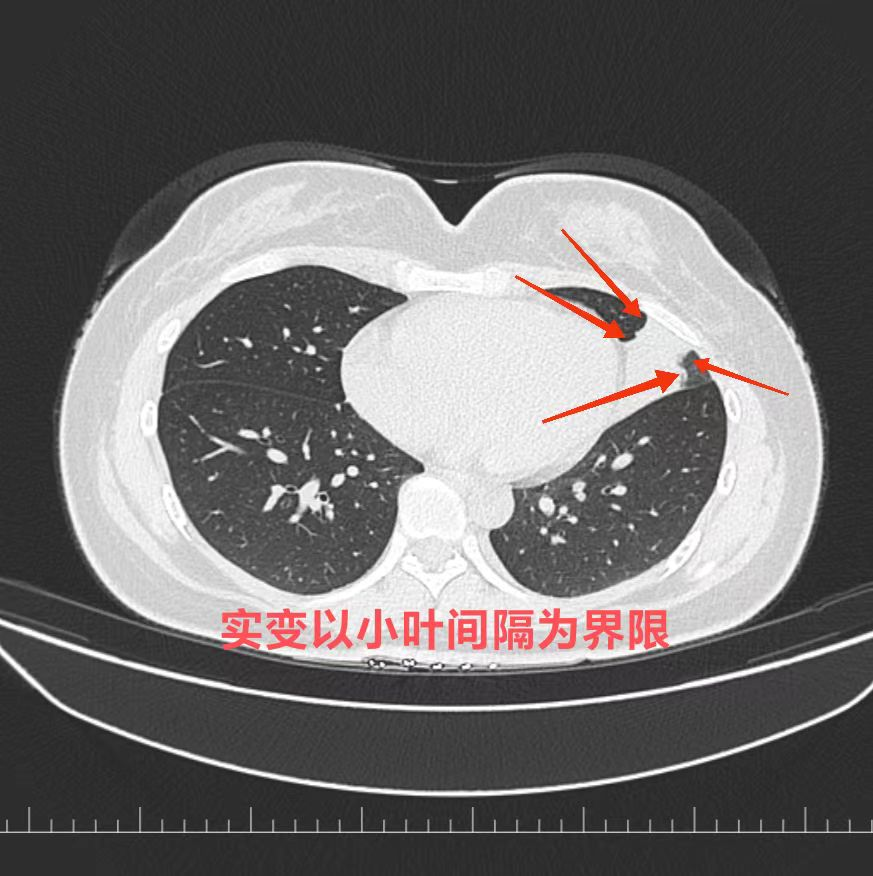 肺部ct片子图片