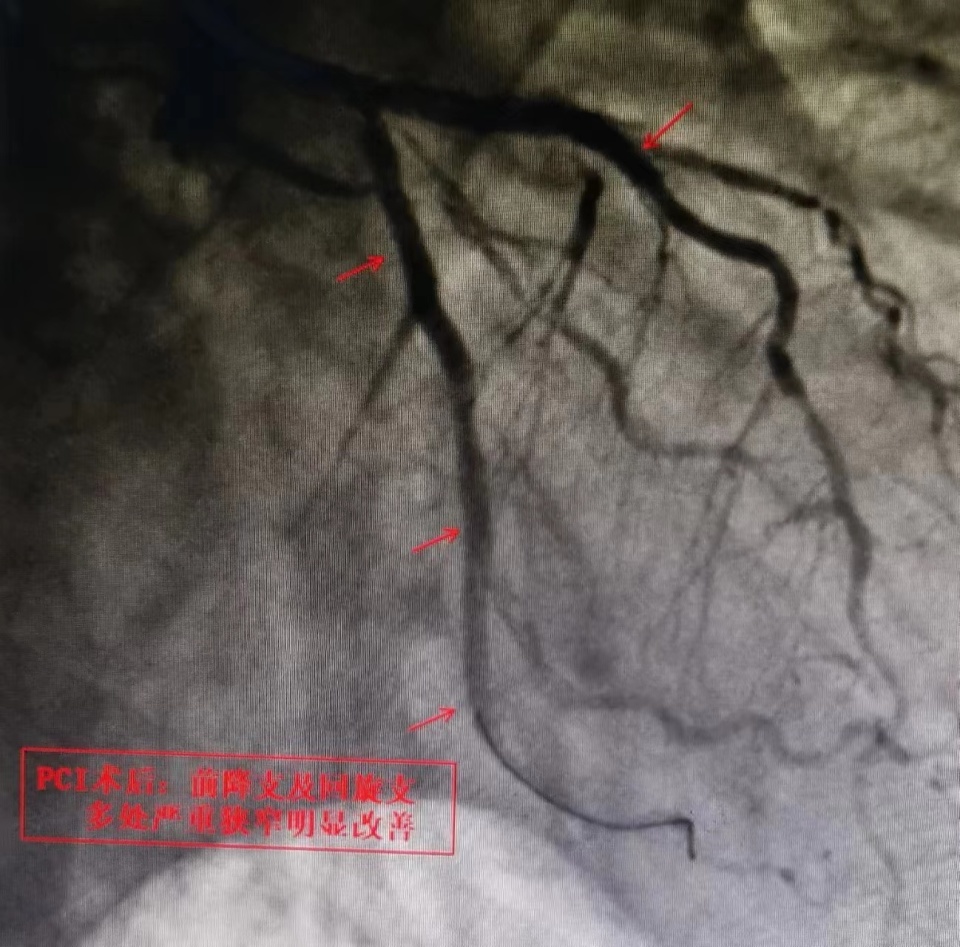 經冠狀動脈造影結果顯示,患者心臟多支主要血管嚴重病變,左前降支,左