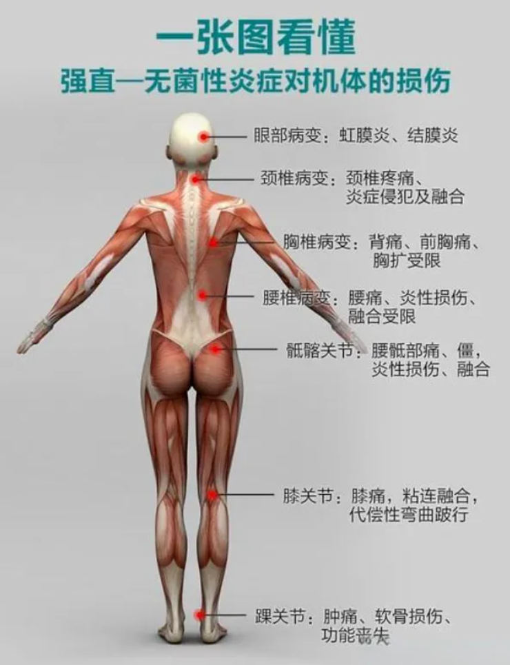 强直性脊柱炎并非不死的癌症!4个常见误解大揭秘