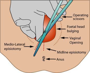 严格意义上,「会阴切开术」(episiotomy)是科研论文和临床指南中最